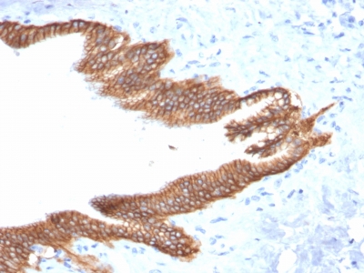 FFPE human pancreatic carcinoma sections stained with 100 ul anti-TROP2 (clone TACSTD2/2152) at 1:100. HIER epitope retrieval prior to staining was performed in 10mM Citrate, pH 6.0.